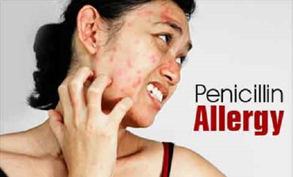 Dị ứng penicillin - Hình ảnh minh họa